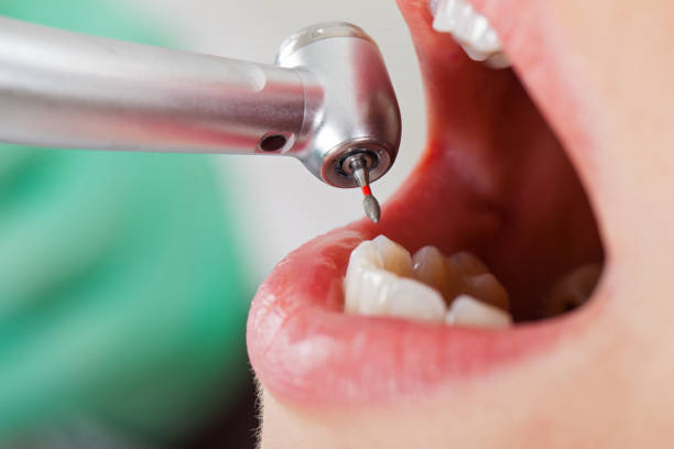 Best Emergency Root Canal Treatment in Sterling, AK
